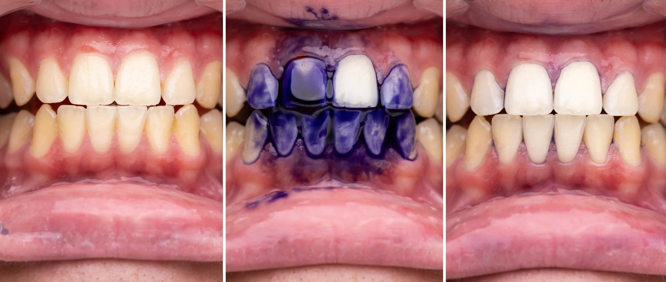 Purple Smile – Bandes Blanchissantes